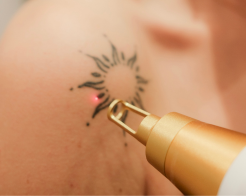 le détatouage au laser